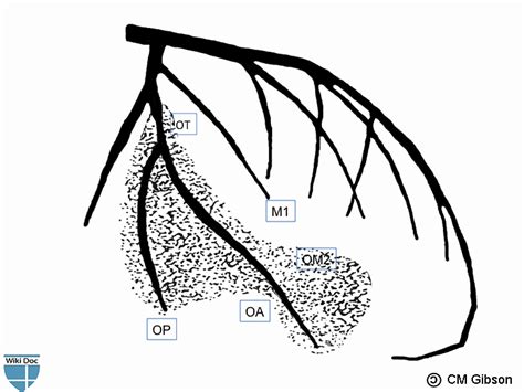 Left coronary artery - wikidoc