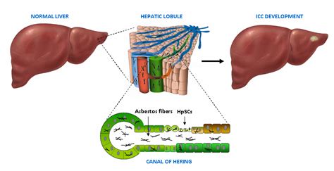 Cells Free Full Text Asbestos And Intrahepatic Cholangiocarcinoma