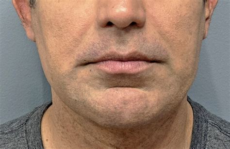 Male Jawline Implant Front 2 Dr Barry Eppley Copy Explore Plastic