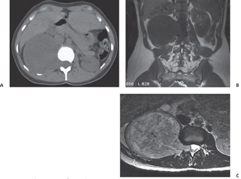 Retroperitoneal Schwannoma Radiology Key