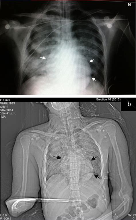 A And B Chest X Ray Wide Areas Of Consolidation Of The Lung