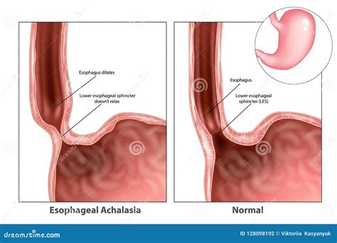 Esophagus Sphincter Anatomy