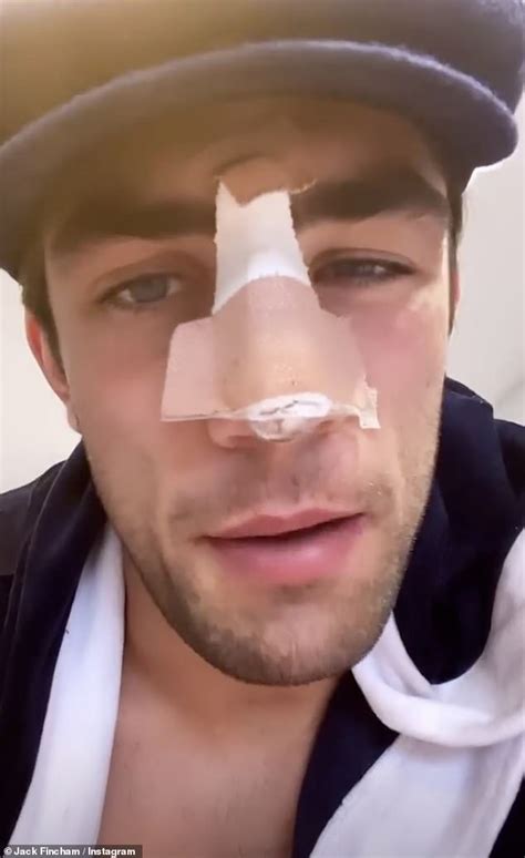 Jack Fincham Unveils Bandaged Nose Following Emergency Surgery And Admits He S In Blistering