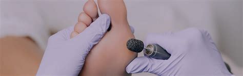 Corns And Callus Unique Soles Mobile Foot Health Care In Doncaster