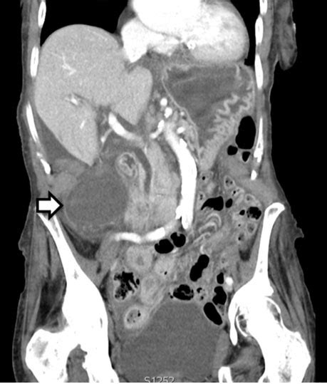 A Case Of Gallbladder Torsion A Rare Cause Of Acute Abdomen Journal Of Case Reports And