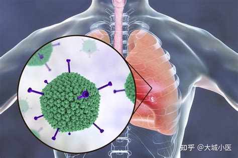 肺炎不可怕，为什么新冠肺炎这么恐怖？普通肺炎和新冠肺炎的区别 知乎