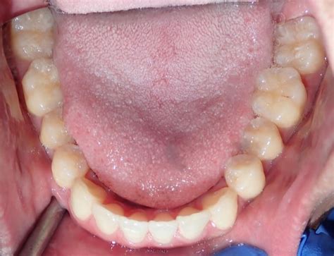 Invisalign Class 3 With Elastics Final