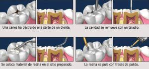 Resina Dental Y Obturaci N En Cartagena Gu A Completa