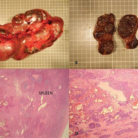 A Macrophotograph Of Enlarged Spleen Showing Multinodular Architecture