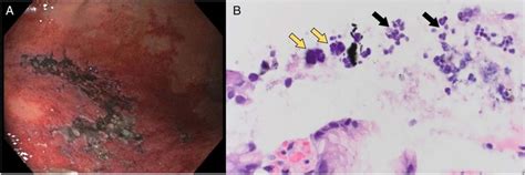 A A Cm Irregular Nonbleeding Necrotic Ulcer In The Gastric Body