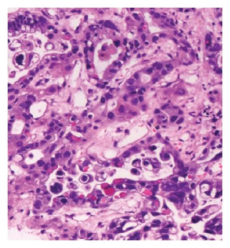 A Gastric Adenocarcinoma Papillary Growth Pattern B Gastric Tumor