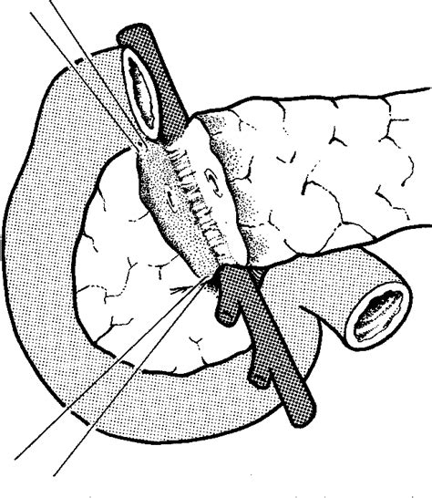 Figure 1 From The Beger Procedure—duodenum Preserving Pancreatic Head Resection Semantic Scholar