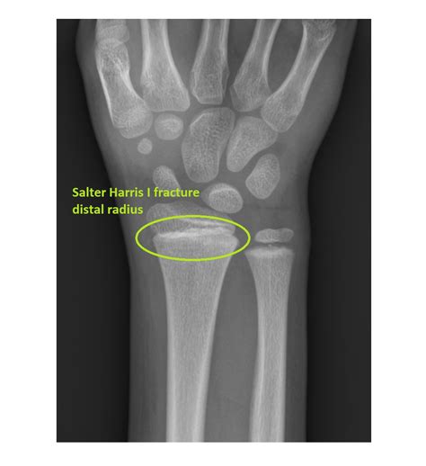 Right Wrist Frontal Salter Harris I Distal Radius Emergucate