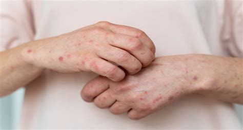 Homeopathic Treatment For Types Of Skin Diseases Homoeocare