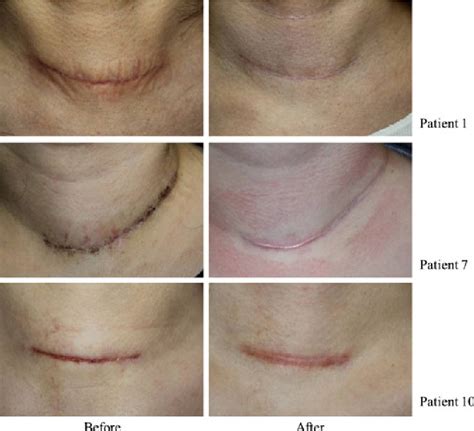 Figure 1 From Appropriate Timing For Thyroidectomy Scar Treatment Using