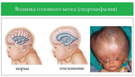 Смешанная гидроцефалия головного мозга симптомы и диагностика лечение