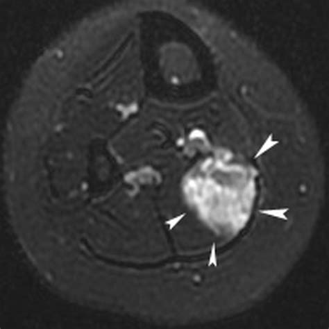 Long Term Outcome Of Single Session Ultrasound Guided Radiofrequency