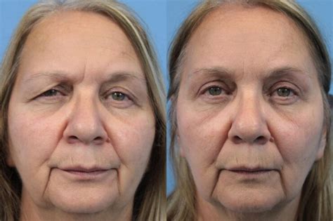 Oculoplastic Surgery And Aging How The Procedure Can Reverse Signs Of