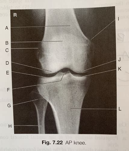 Chapter 7 Anatomy AP Knee Flashcards Quizlet