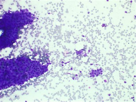 Pathology Outlines Warthin Tumor