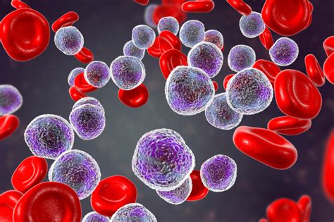 Leucemia Linfoide Cr Nica Llc Sintomas E Caracter Sticas Gen Ticas