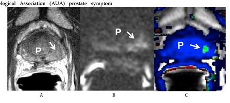 Figure From Multi Parametric Mri Directed Focal Salvage Permanent