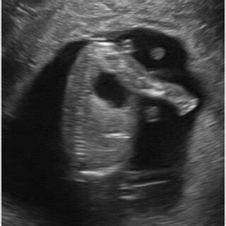 Ultrasound revealing an anechoic structure in the lower abdomen ...