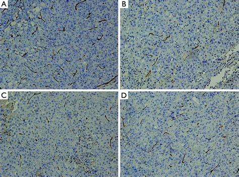 Immunohistochemical Staining Showed A Positive Cd34 Reaction ×200