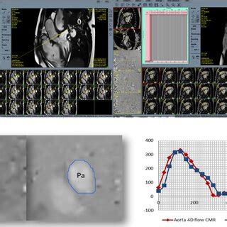 4D CMR Flow Across The MPA With Velocity Colorcoded Streamlines Showed