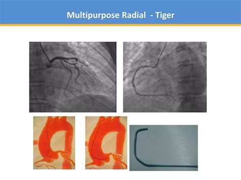 Catheters Used In Angiography And Angioplasty Ppt