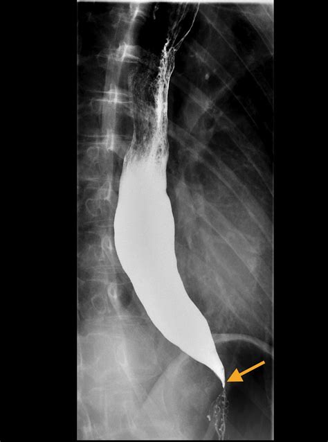 Achalasia Barium Swallow Radiology At St Vincent S University Hospital