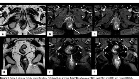 Figure From Our Experience With Mr Imaging Of Perianal Fistulas