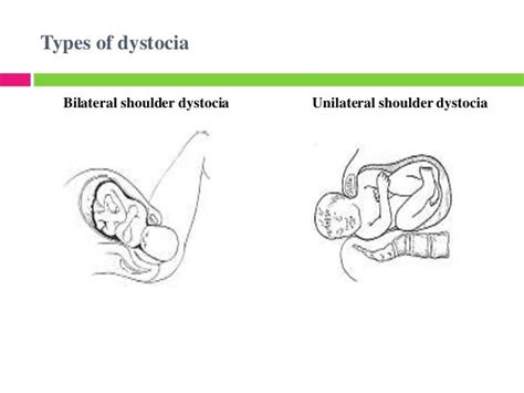 Shoulder dystocia / distocija fetlnih ramena