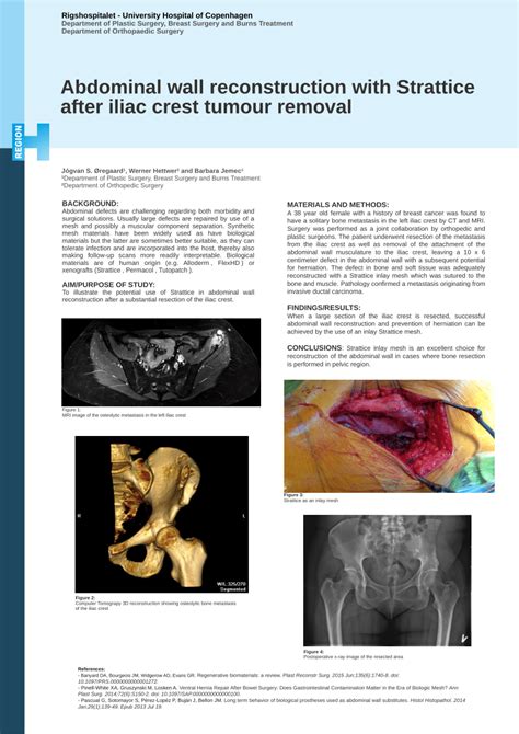 Pdf Abdominal Wall Reconstruction With Strattice After Iliac Crest Tumour Removal