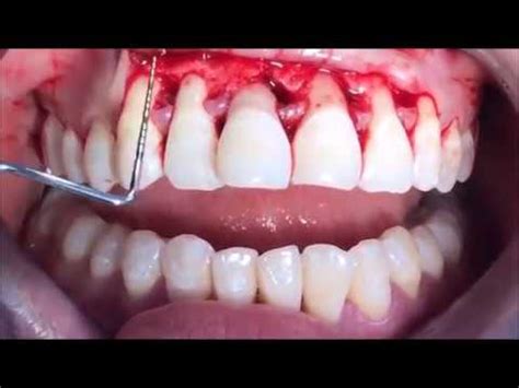 Cirurgia Periodontal Regenerativa YouTube