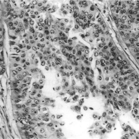 Invasive Adenosquamous Carcinoma Of The Cervix Original Magnification