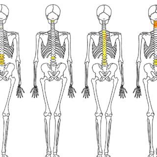 Localizaci N De Artropat As Degenerativas En La Columna Vertebral De