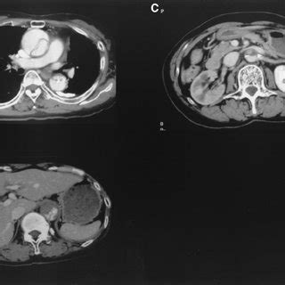 Axial A And B And Sagittal C Ct Images Of A Retrograde Type A