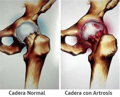 ARTROSIS DE CADERA