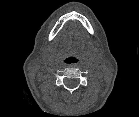 Lingual Foramen