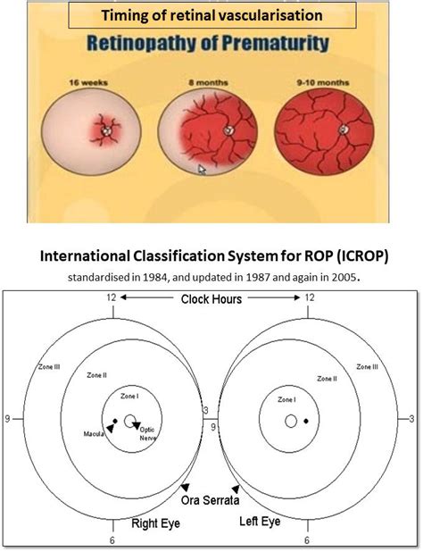 Retinopathy Of Prematurity A Nicu Based Approach Intechopen