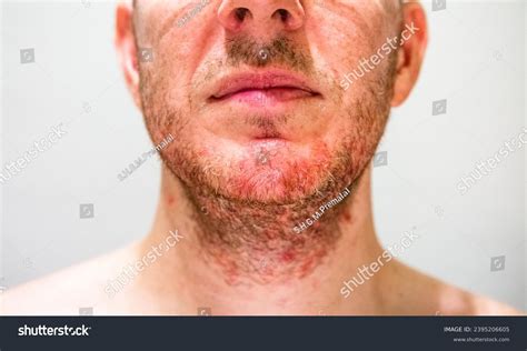 Skin Distress Perioral Dermatitis Seborrheic Dermatitis Stock Photo