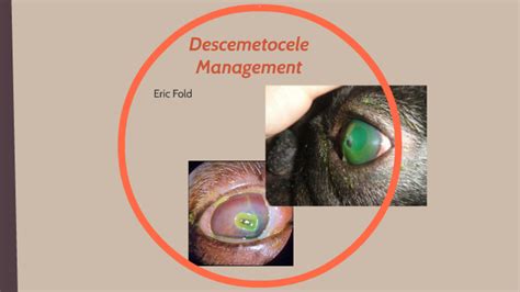 Descemetocele Management By Eric Fold On Prezi