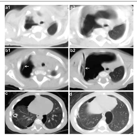 Figure From Huge Congenital Cystic Lung Lesion Mimicking Tension