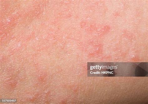 Psoriasis Fotografías E Imágenes De Stock Getty Images