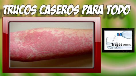 Como Tratar La Urticaria Con Remedios Caseros Naturales Urticaria