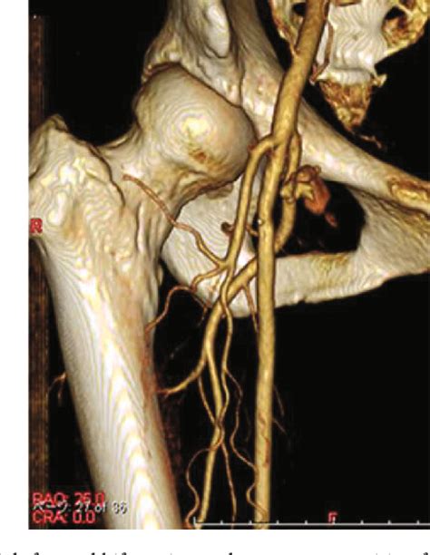 Figure From Viabahn Stent Graft Implantation For Iatrogenic