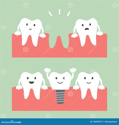 Filling Dental Implant With Crown Before And After Stock Vector