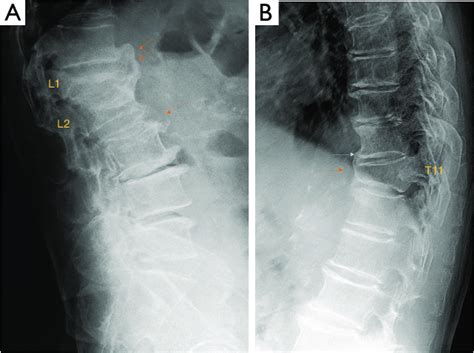 Formation of osteophyte bridging to stable the spine. (A) Radiograph of ...