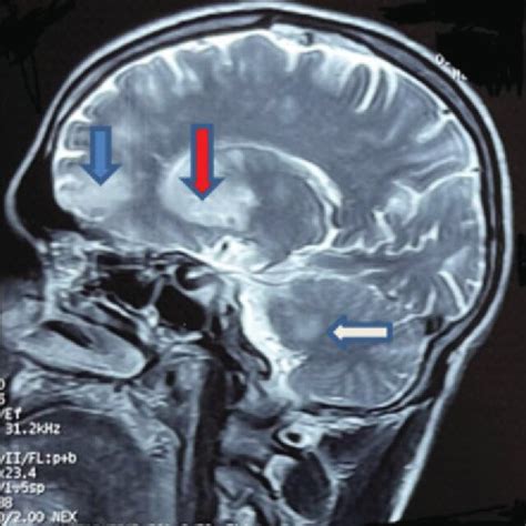 T2-weighted sagittal section Magnetic resonance imaging (MRI) brain ...